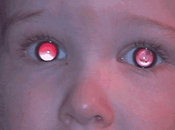 cataract red reflex